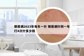 银屑病2023年每年一针 银屑病针剂一年打4次针多少钱