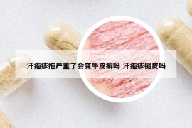 汗疱疹拖严重了会变牛皮癣吗 汗疱疹褪皮吗