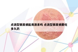 点滴型银屑病能用激素吗 点滴型银屑病要吃多久药