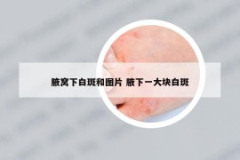 腋窝下白斑和图片 腋下一大块白斑