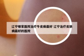 辽宁哪家医院治疗牛皮癣最好 辽宁治疗皮肤病最好的医院