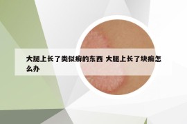 大腿上长了类似癣的东西 大腿上长了块癣怎么办