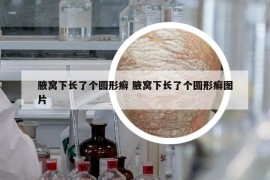 腋窝下长了个圆形癣 腋窝下长了个圆形癣图片