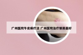 广州医院牛皮癣疗法 广州医院治疗银屑最好