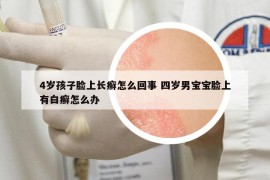 4岁孩子脸上长癣怎么回事 四岁男宝宝脸上有白癣怎么办