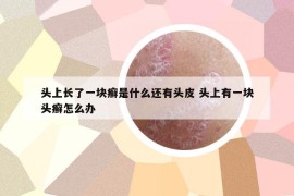 头上长了一块癣是什么还有头皮 头上有一块头癣怎么办