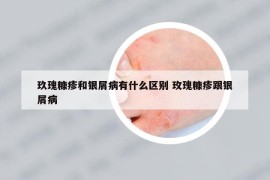 玖瑰糠疹和银屑病有什么区别 玫瑰糠疹跟银屑病