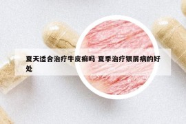 夏天适合治疗牛皮癣吗 夏季治疗银屑病的好处