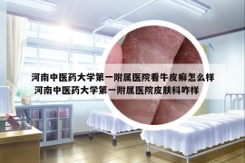 河南中医药大学第一附属医院看牛皮癣怎么样 河南中医药大学第一附属医院皮肤科咋样