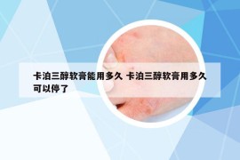 卡泊三醇软膏能用多久 卡泊三醇软膏用多久可以停了