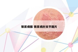 银屑病髁 银屑病肘关节图片