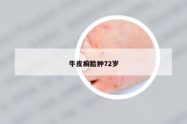 牛皮癣脸肿72岁