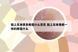 腿上出来很多癣是什么意思 腿上出来像癣一样的那是什么