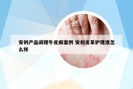 安利产品调理牛皮癣案例 安利皮革护理液怎么样