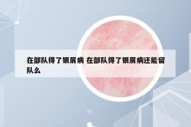 在部队得了银屑病 在部队得了银屑病还能留队么