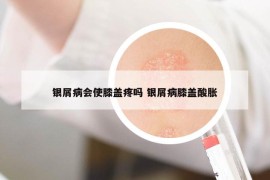 银屑病会使膝盖疼吗 银屑病膝盖酸胀