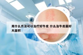 用什么方法可以治疗好牛皮 什么治牛皮最好大面积