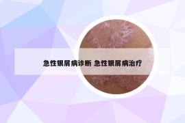 急性银屑病诊断 急性银屑病治疗