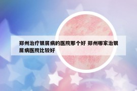 郑州治疗银屑病的医院那个好 郑州哪家治银屑病医院比较好