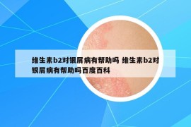 维生素b2对银屑病有帮助吗 维生素b2对银屑病有帮助吗百度百科