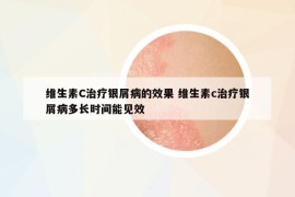 维生素C治疗银屑病的效果 维生素c治疗银屑病多长时间能见效