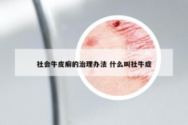 社会牛皮癣的治理办法 什么叫社牛症