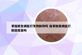 掌指脓包病能打生物制剂吗 指掌脓疱病能打新冠疫苗吗