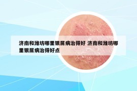 济南和潍坊哪里银屑病治得好 济南和潍坊哪里银屑病治得好点