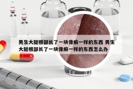 男生大腿根部长了一块像癣一样的东西 男生大腿根部长了一块像癣一样的东西怎么办