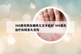 308激光照白癜风几次才能好 308激光治疗白斑多久见效