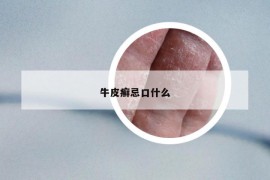 牛皮癣忌口什么