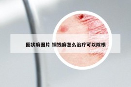 圈状癣图片 铜钱癣怎么治疗可以除根