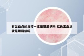 有出血点的皮疹一定是银屑病吗 红色出血点就是银屑病吗