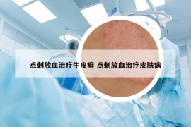 点刺放血治疗牛皮癣 点刺放血治疗皮肤病