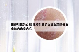 湿疹引起的白斑 湿疹引起的白斑会跟随着宝宝长大也变大吗