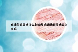 点滴型银屑病往头上长吗 点滴状银屑病头上有吗