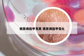 银屑病指甲发黑 银屑病指甲变化