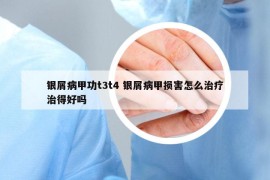 银屑病甲功t3t4 银屑病甲损害怎么治疗治得好吗