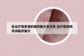 能治疗银屑病的最好偏方有没有 治疗银屑病民间最灵偏方