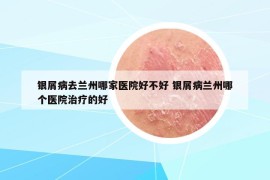 银屑病去兰州哪家医院好不好 银屑病兰州哪个医院治疗的好