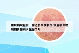 银屑病现在有一种进口生物制剂 银屑病生物制剂价格纳入医保了吗