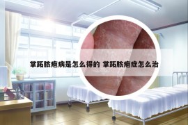 掌跖脓疱病是怎么得的 掌跖脓疱症怎么治