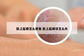 脸上起癣怎么修复 脸上起癣该怎么办