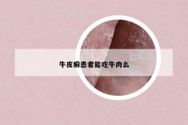 牛皮癣患者能吃牛肉么