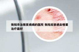 衡阳市治银屑病病的医院 衡阳皮肤病去哪里治疗最好