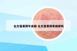 北方容易得牛皮癣 北方容易得荨麻疹吗