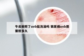 牛皮癣照了uvb能洗澡吗 银屑病uvb需要照多久