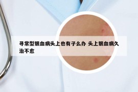 寻常型银血病头上也有子么办 头上银血病久治不愈