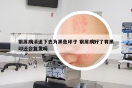 银屑病消退下去为黑色印子 银屑病好了有黑印还会复发吗