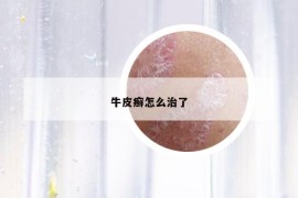 牛皮癣怎么治了